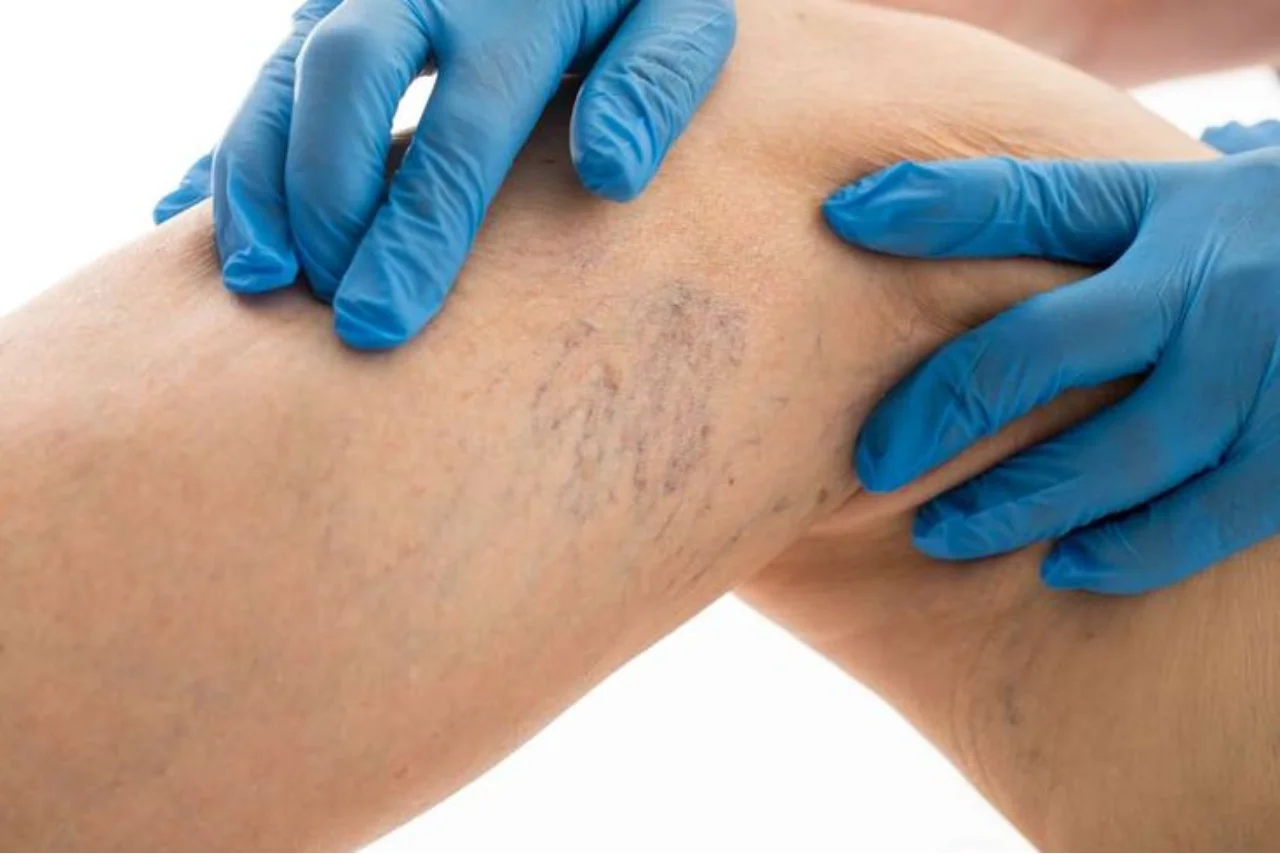 Sclerotherapy